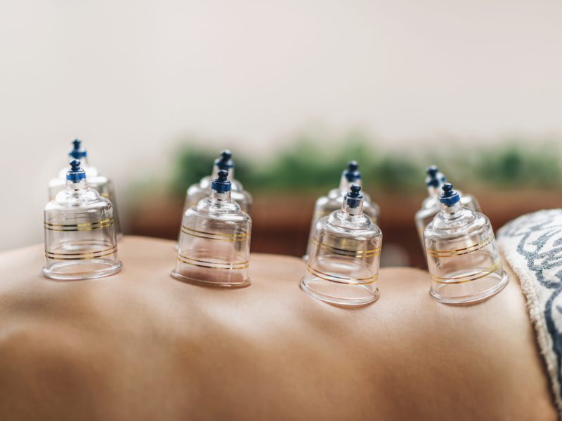 Hijama cupping treatment on women's back